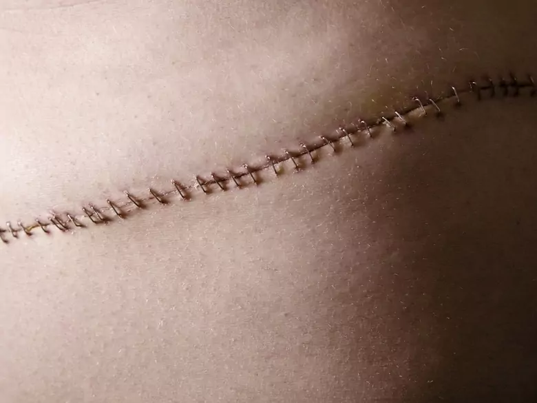 Kremy na blizny – czy są bezpieczne i skuteczne?