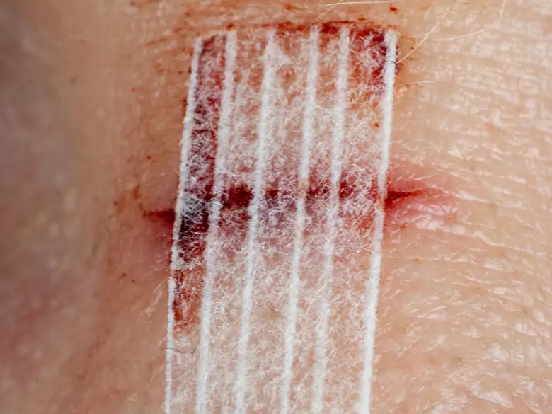 Jak przyspieszyć gojenie ran?