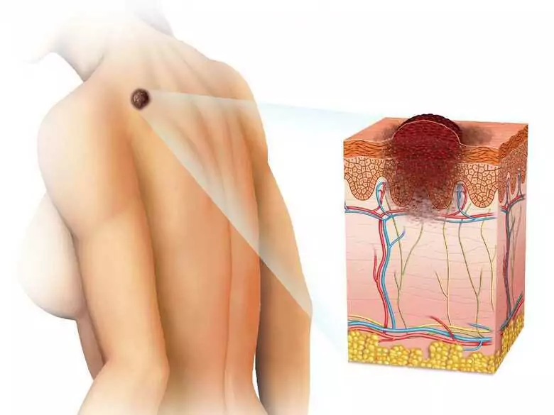 Rak skóry i stany przednowotworowe