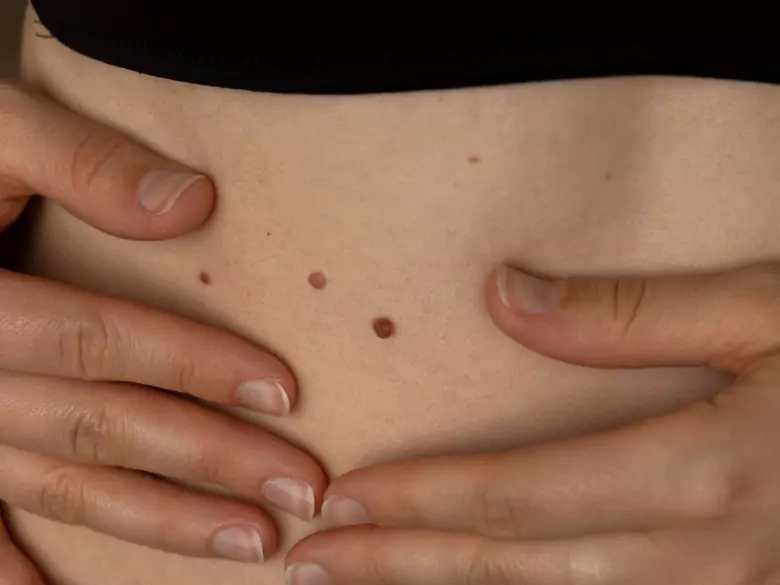 Nowy sposób naukowców na wykrycie raka skóry