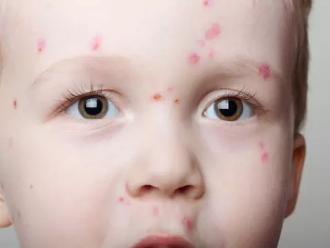 Czy mydło może uczulać?