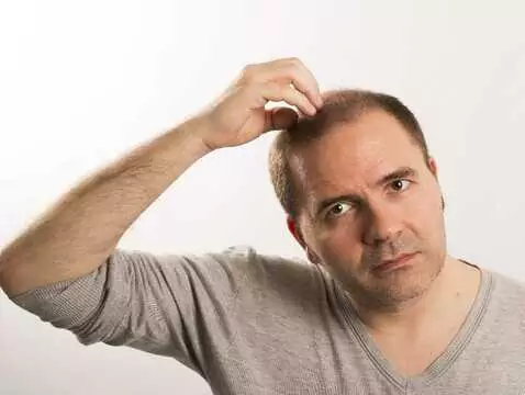 Niedobór witaminy D może sprzyjać łysieniu