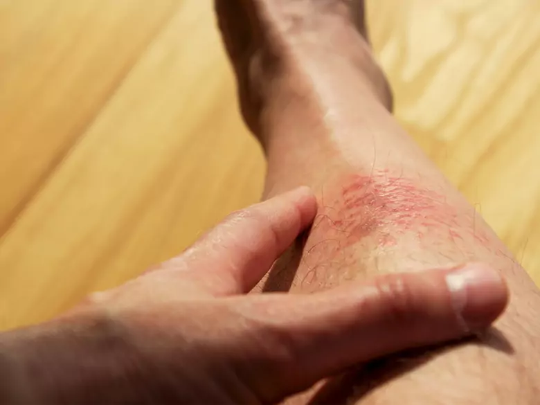 Piodermia zgorzelinowa – co to takiego?