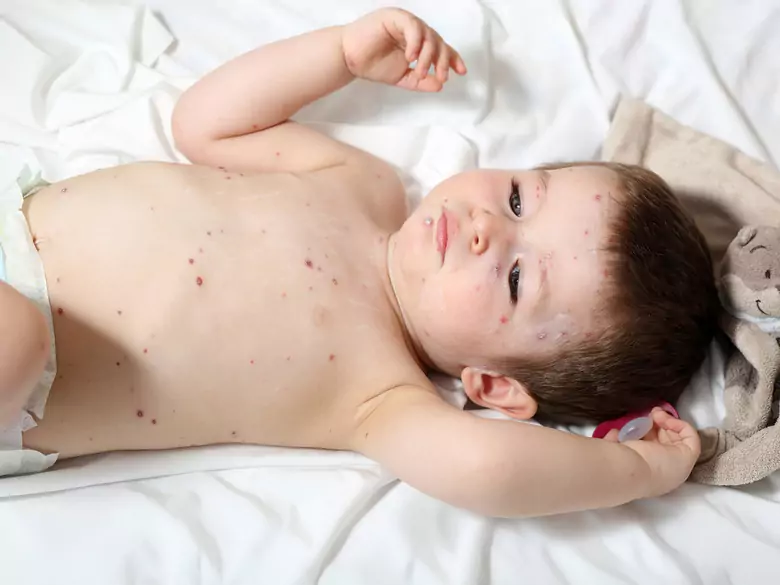 Atopowe zapalenie skóry – objawy kliniczne i leczenie