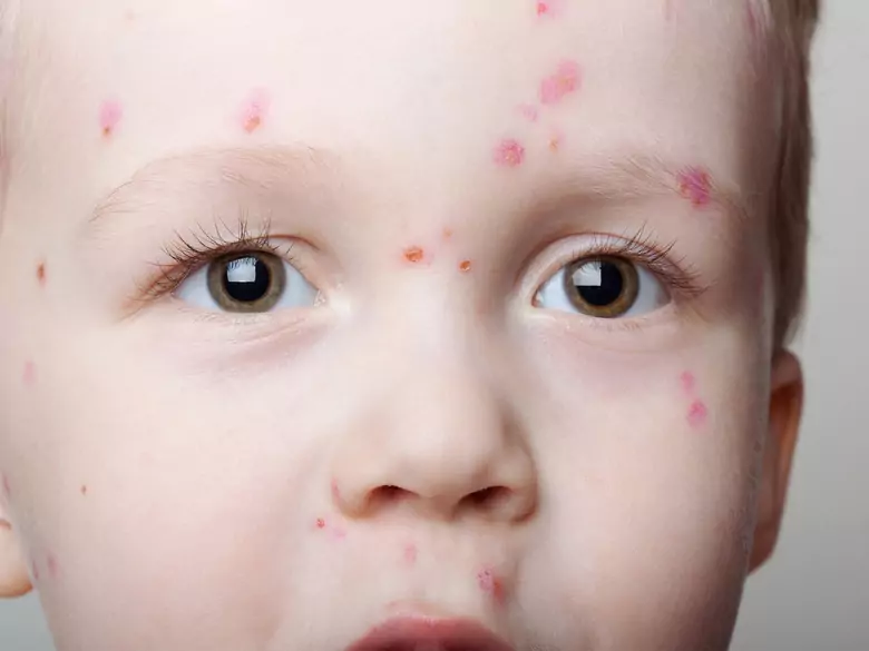 Czy mydło może uczulać?