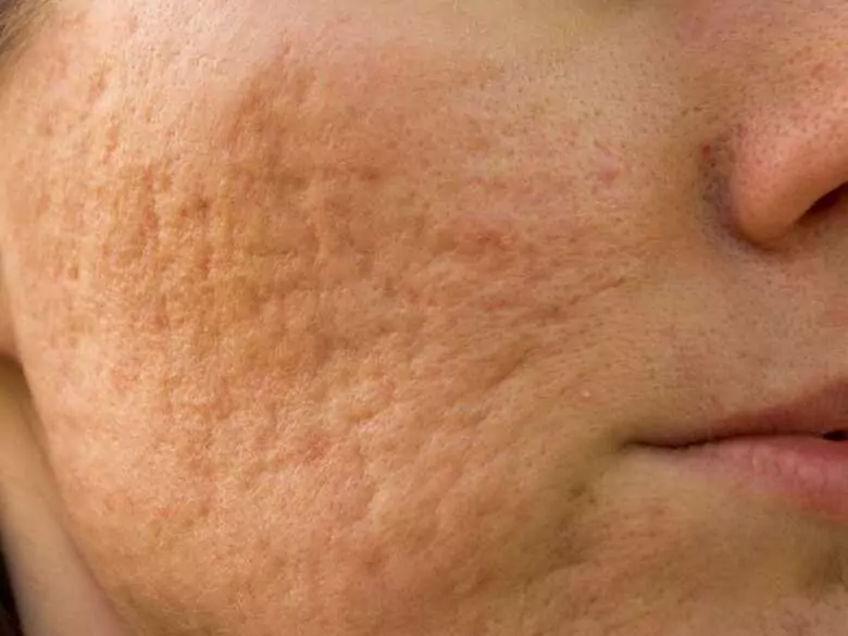 Biomikroigły wchodzą do domowej pielęgnacji. Trend gabinetowy przenosi się do domowych rytuałów