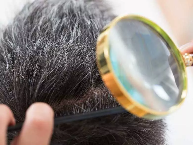 Łupież pstry – czy jest groźny ?